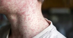 Measles alerts issued in San Antonio, New Braunfels and San Marcos as Texas outbreak spreads