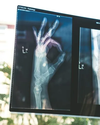 Scientists use bioactive glass to treat bone cancer