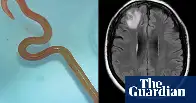 Live worm found in Australian woman’s brain in world-first discovery