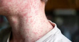 Measles is making a comeback in Canada. What’s driving the surge? - National | Globalnews.ca